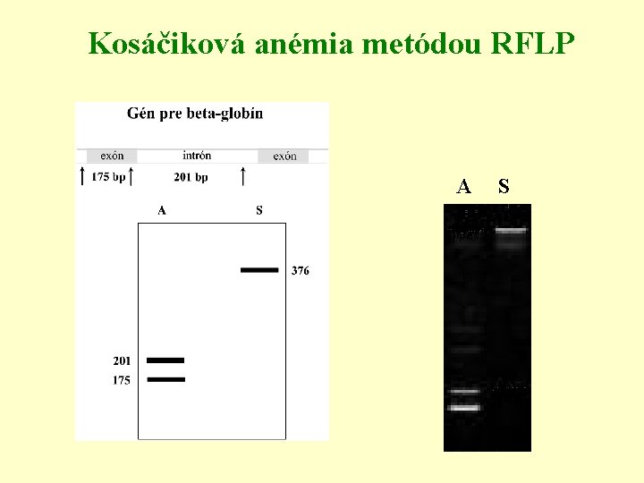 Kosáčiková anémia metódou RFLP A S 