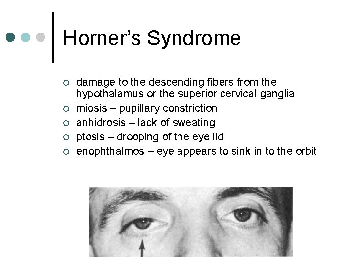 Horner’s Syndrome ¢ ¢ ¢ damage to the descending fibers from the hypothalamus or