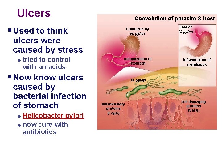Ulcers Coevolution of parasite & host § Used to think Colonized by H. pylori