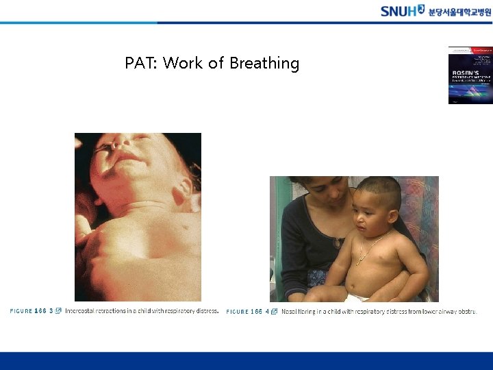 PAT: Work of Breathing 