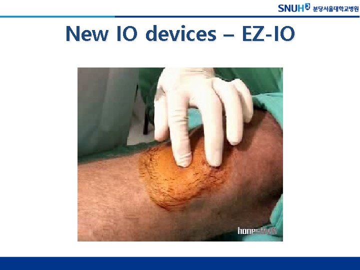 New IO devices – EZ-IO 