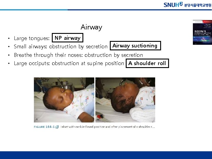 Airway • Large tongues: NP airway • Small airways: obstruction by secretion Airway suctioning