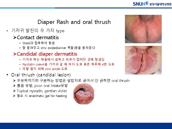 Diaper Rash and oral thrush • 기저귀 발진의 두 가지 type ØContact dermatitis •