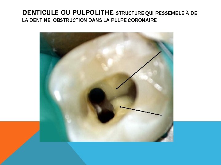 DENTICULE OU PULPOLITHE: STRUCTURE QUI RESSEMBLE À DE LA DENTINE, OBSTRUCTION DANS LA PULPE