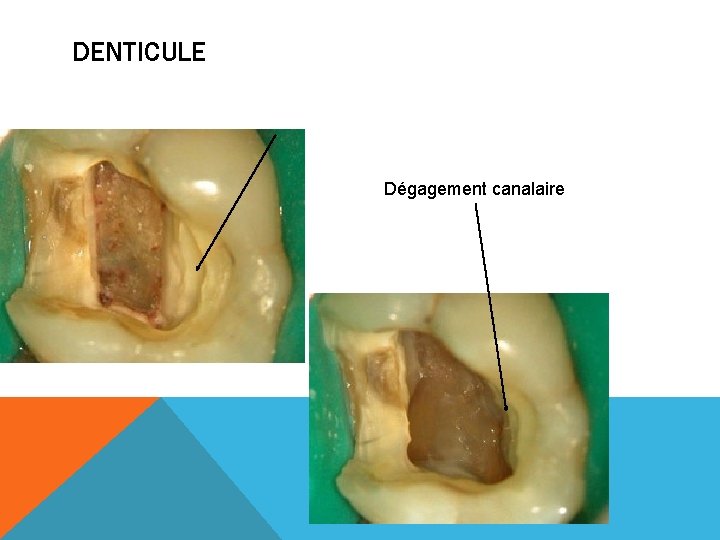 DENTICULE Dégagement canalaire 
