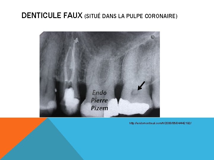 DENTICULE FAUX (SITUÉ DANS LA PULPE CORONAIRE) http: //endomontreal. com/fr/2008/06/04/442192/ 