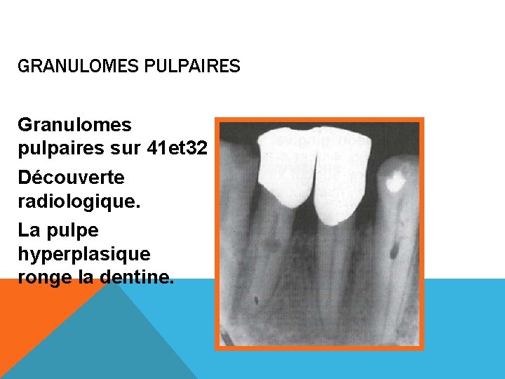 GRANULOMES PULPAIRES Granulomes pulpaires sur 41 et 32 Découverte radiologique. La pulpe hyperplasique ronge