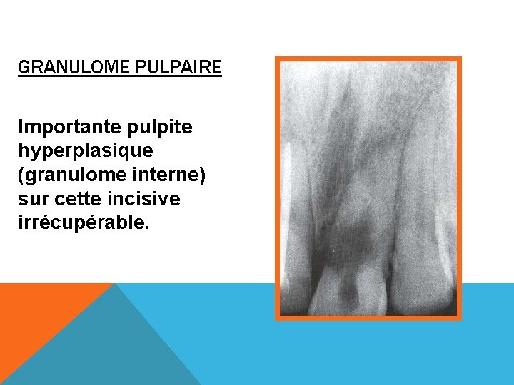 GRANULOME PULPAIRE Importante pulpite hyperplasique (granulome interne) sur cette incisive irrécupérable. 