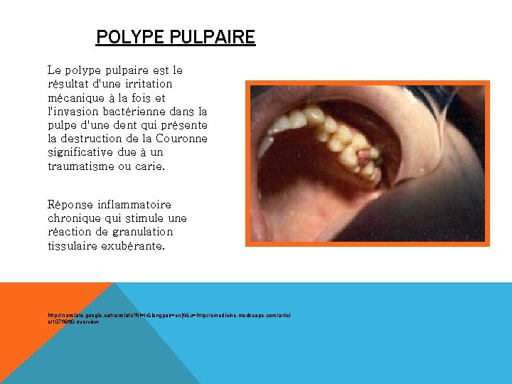 POLYPE PULPAIRE Le polype pulpaire est le résultat d'une irritation mécanique à la fois