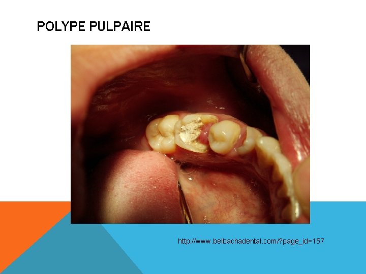 POLYPE PULPAIRE http: //www. belbachadental. com/? page_id=157 