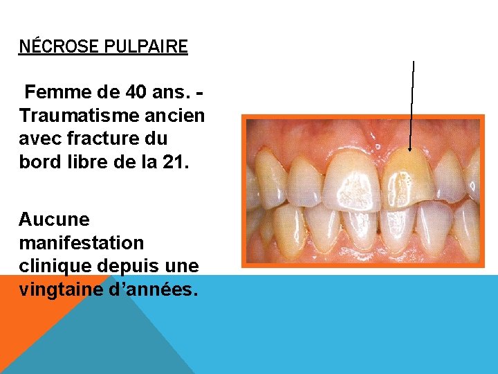 NÉCROSE PULPAIRE Femme de 40 ans. Traumatisme ancien avec fracture du bord libre de