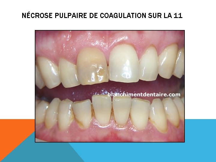 NÉCROSE PULPAIRE DE COAGULATION SUR LA 11 