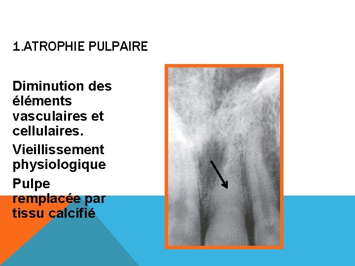 1. ATROPHIE PULPAIRE Diminution des éléments vasculaires et cellulaires. Vieillissement physiologique Pulpe remplacée par