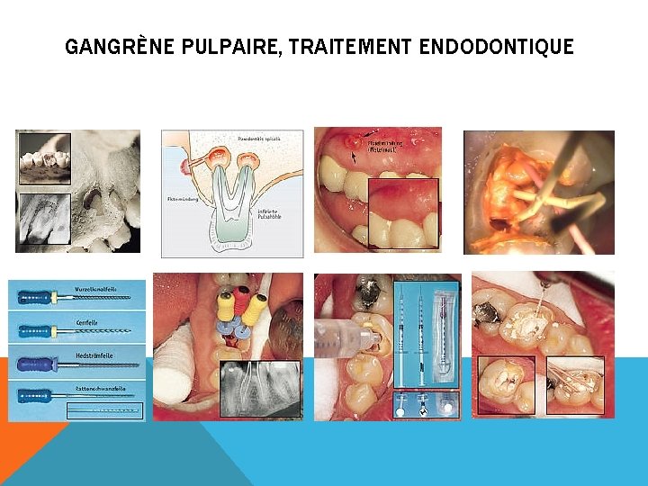 GANGRÈNE PULPAIRE, TRAITEMENT ENDODONTIQUE 