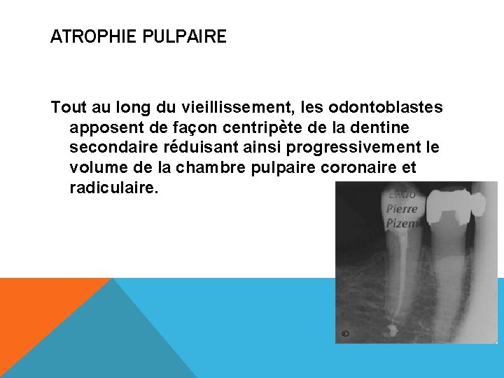 ATROPHIE PULPAIRE Tout au long du vieillissement, les odontoblastes apposent de façon centripète de