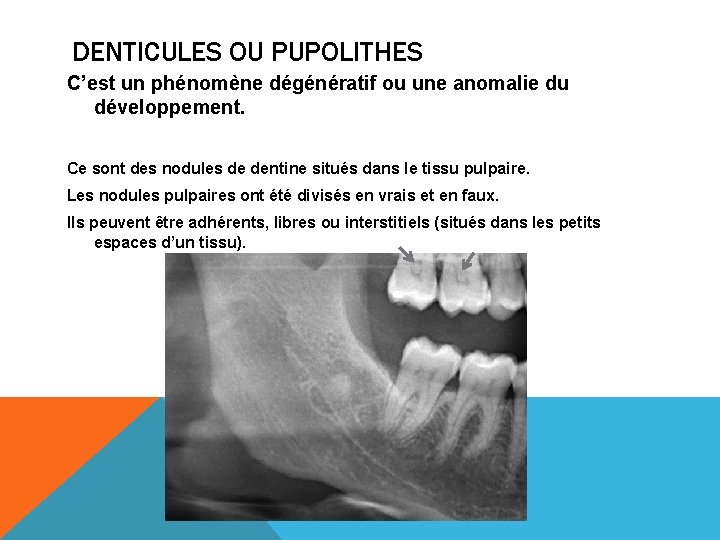 DENTICULES OU PUPOLITHES C’est un phénomène dégénératif ou une anomalie du développement. Ce sont