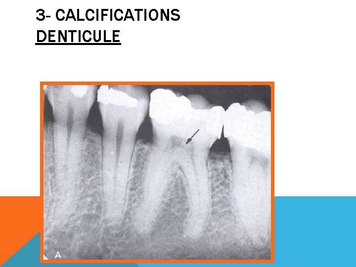 3 - CALCIFICATIONS DENTICULE 