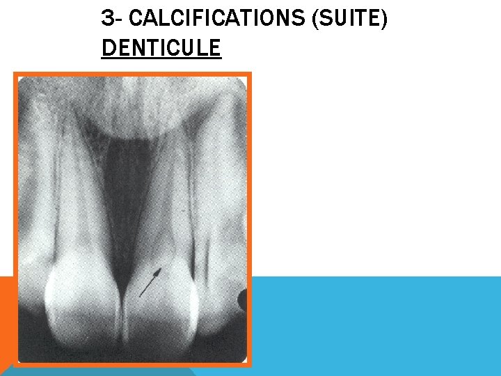 3 - CALCIFICATIONS (SUITE) DENTICULE 