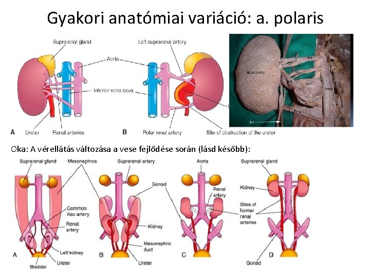 Gyakori anatómiai variáció: a. polaris Oka: A vérellátás változása a vese fejlődése során (lásd