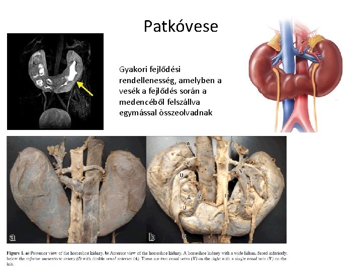 Patkóvese Gyakori fejlődési rendellenesség, amelyben a vesék a fejlődés során a medencéből felszállva egymással