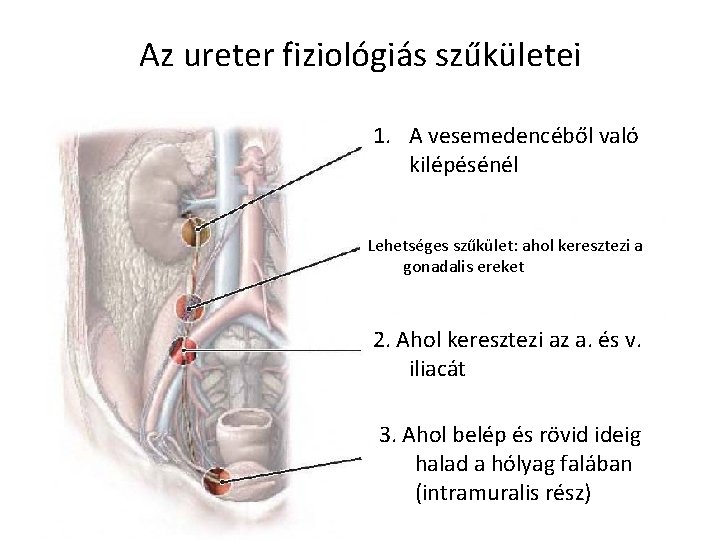 Az ureter fiziológiás szűkületei 1. A vesemedencéből való kilépésénél Lehetséges szűkület: ahol keresztezi a