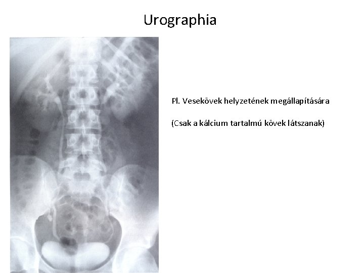 Urographia Pl. Vesekövek helyzetének megállapítására (Csak a kálcium tartalmú kövek látszanak) 