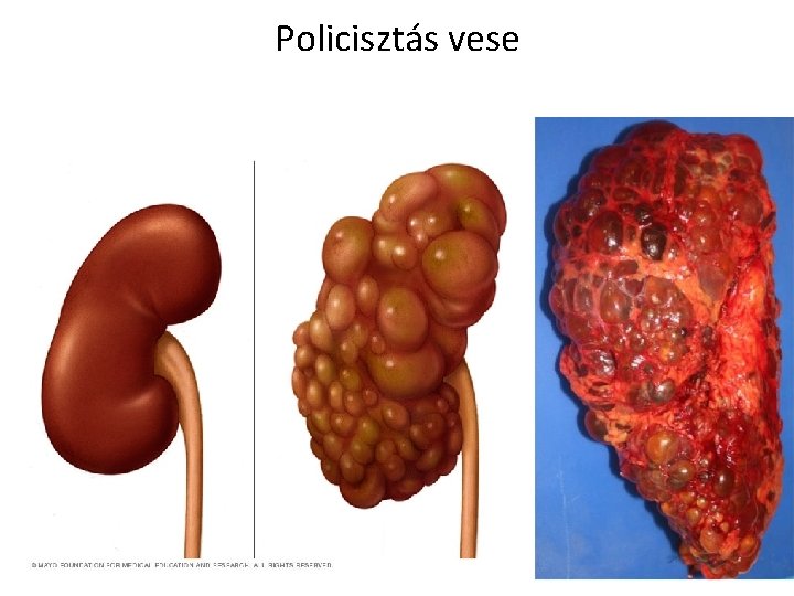 Policisztás vese 