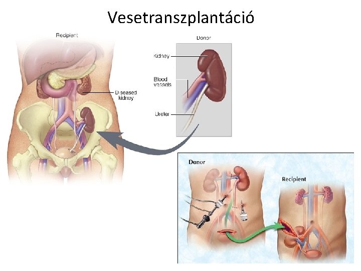 Vesetranszplantáció 