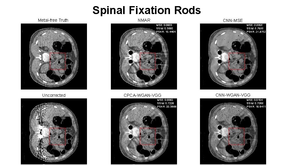 Spinal Fixation Rods Metal-free Truth NMAR CNN-MSE MSE: 0. 0903 SSIM: 0. 3590 PSNR: