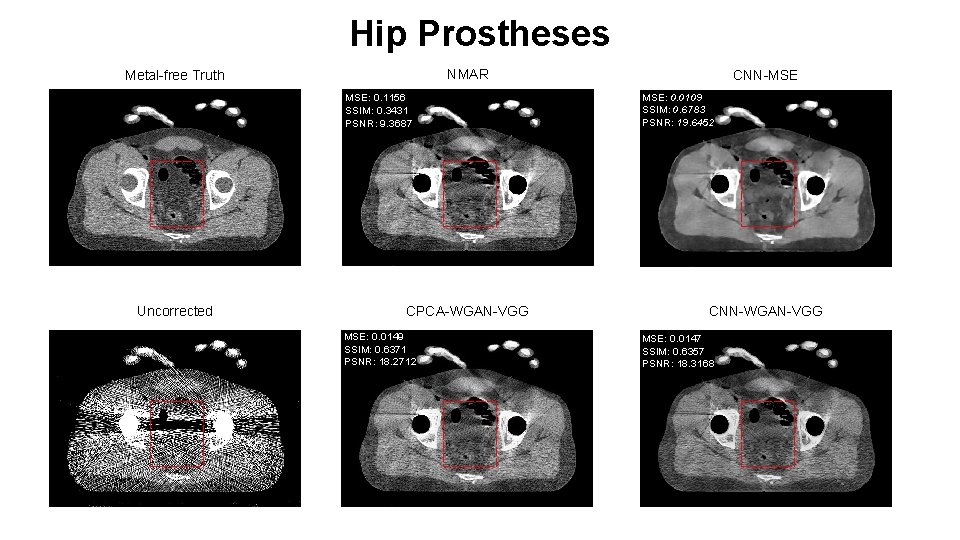 Hip Prostheses NMAR Metal-free Truth MSE: 0. 1156 SSIM: 0. 3431 PSNR: 9. 3687