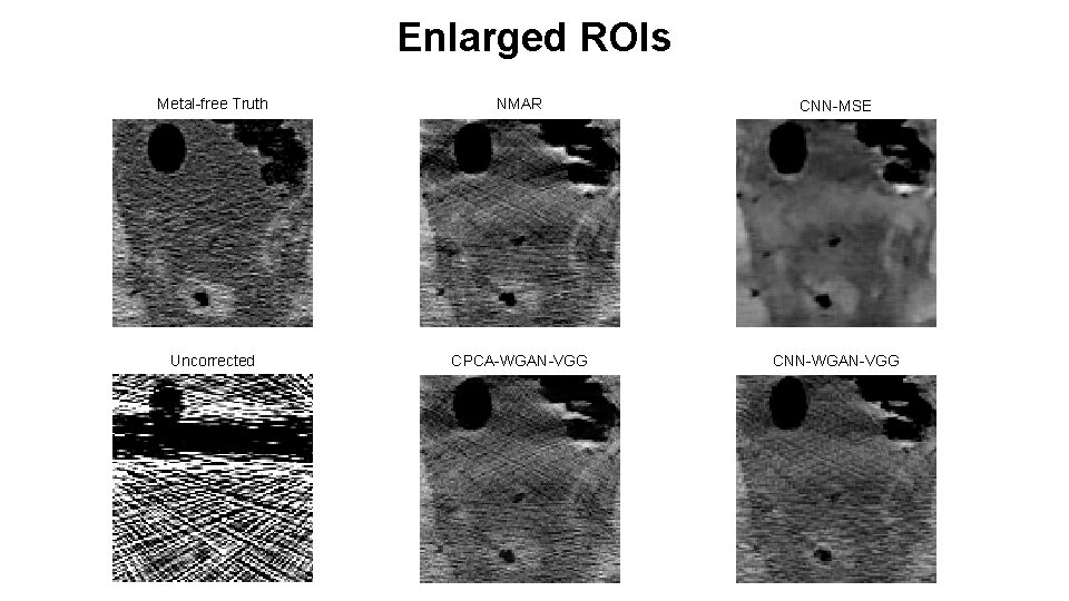 Enlarged ROIs Metal-free Truth NMAR CNN-MSE Uncorrected CPCA-WGAN-VGG CNN-WGAN-VGG 