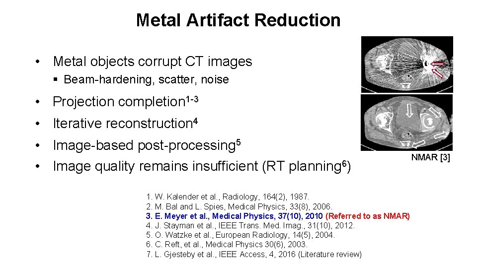 Metal Artifact Reduction • Metal objects corrupt CT images § Beam-hardening, scatter, noise •