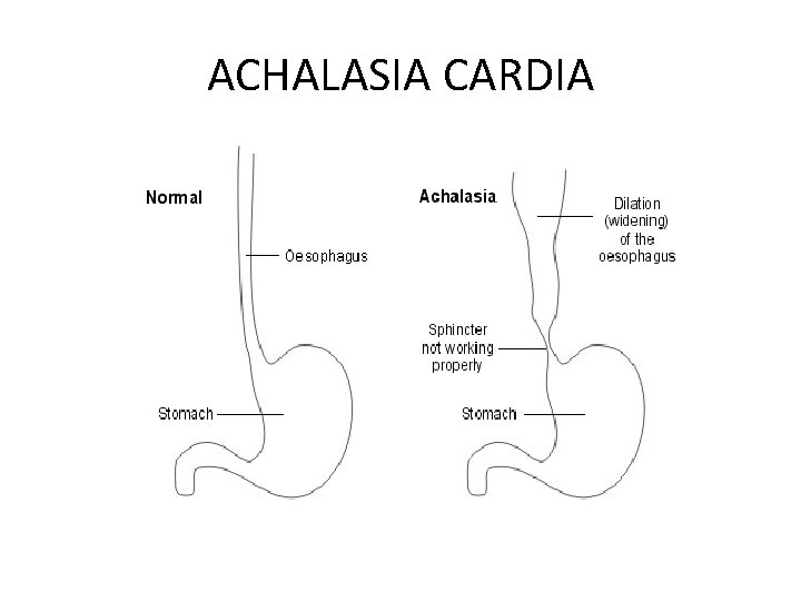 ACHALASIA CARDIA 