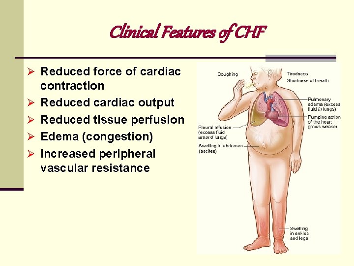 Clinical Features of CHF Ø Reduced force of cardiac Ø Ø contraction Reduced cardiac Clinical Features of CHF Ø Reduced force of cardiac Ø Ø contraction Reduced cardiac