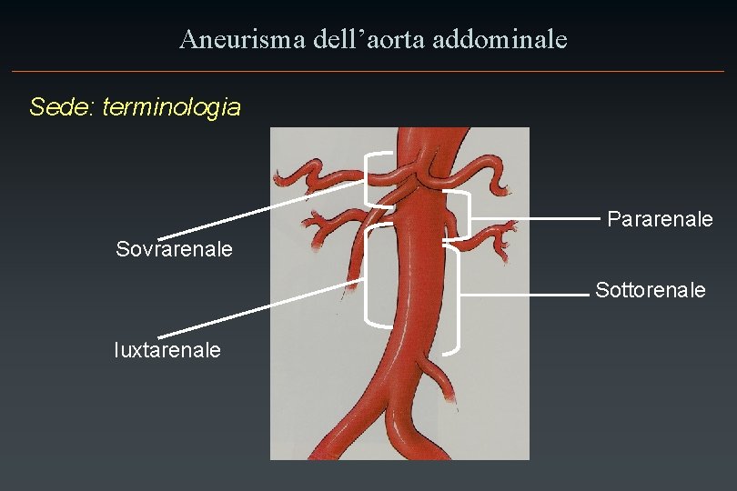 Aneurisma dell’aorta addominale Sede: terminologia Pararenale Sovrarenale Sottorenale Iuxtarenale 