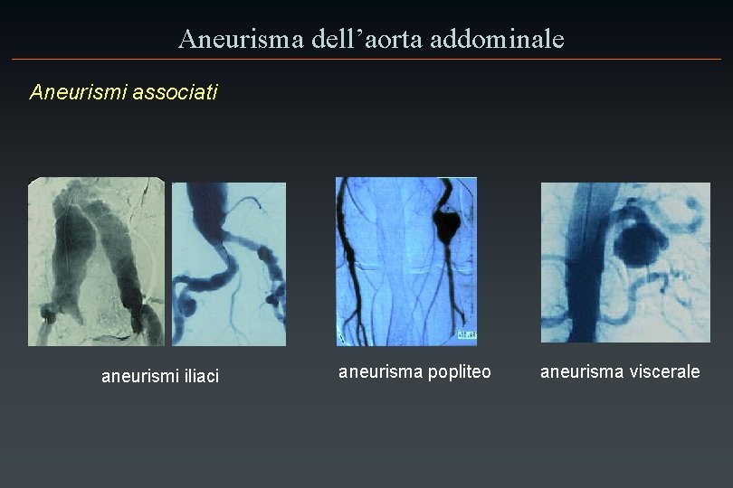 Aneurisma dell’aorta addominale Aneurismi associati aneurismi iliaci aneurisma popliteo aneurisma viscerale 