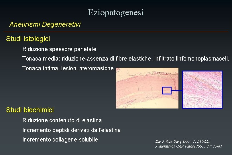 Eziopatogenesi Aneurismi Degenerativi Studi istologici Riduzione spessore parietale Tonaca media: riduzione-assenza di fibre elastiche,