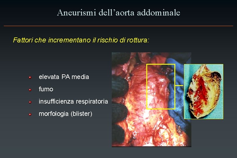 Aneurismi dell’aorta addominale Fattori che incrementano il rischio di rottura: elevata PA media fumo