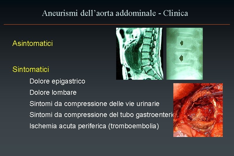 Aneurismi dell’aorta addominale - Clinica Asintomatici Sintomatici Dolore epigastrico Dolore lombare Sintomi da compressione
