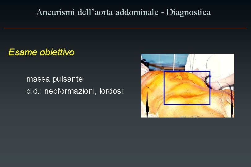 Aneurismi dell’aorta addominale - Diagnostica Esame obiettivo massa pulsante d. d. : neoformazioni, lordosi