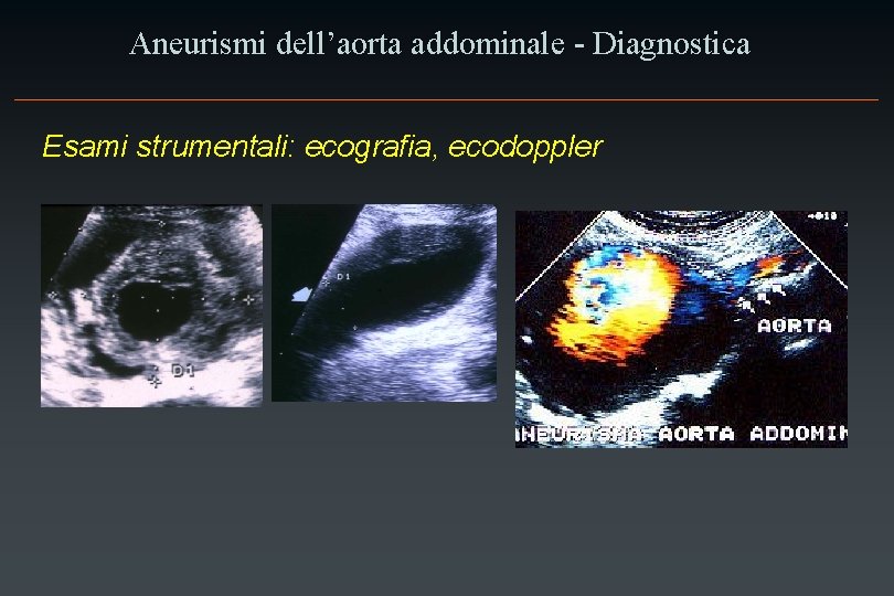 Aneurismi dell’aorta addominale - Diagnostica Esami strumentali: ecografia, ecodoppler 