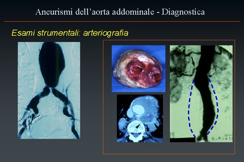 Aneurismi dell’aorta addominale - Diagnostica Esami strumentali: arteriografia 