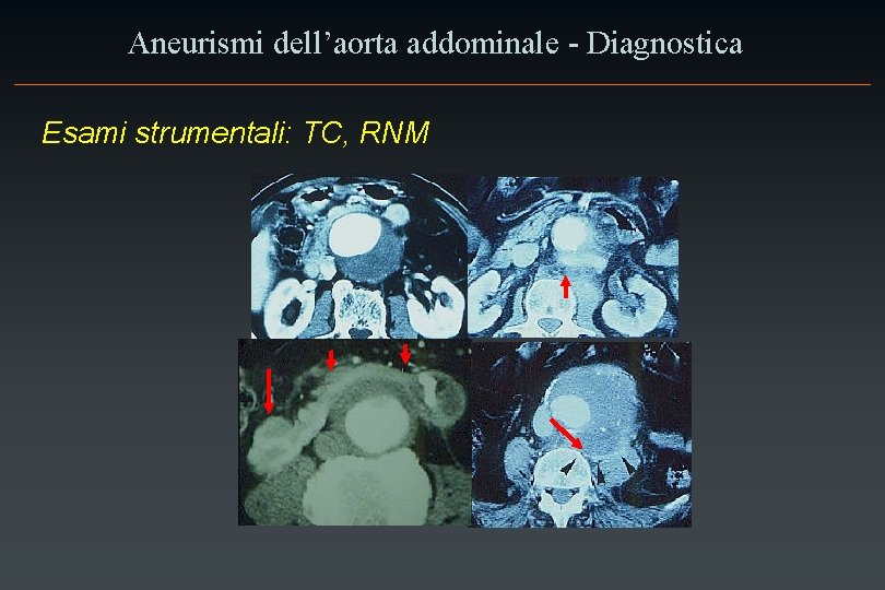 Aneurismi dell’aorta addominale - Diagnostica Esami strumentali: TC, RNM 