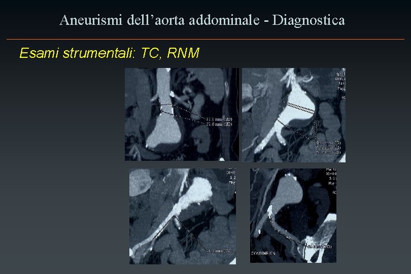 Aneurismi dell’aorta addominale - Diagnostica Esami strumentali: TC, RNM 