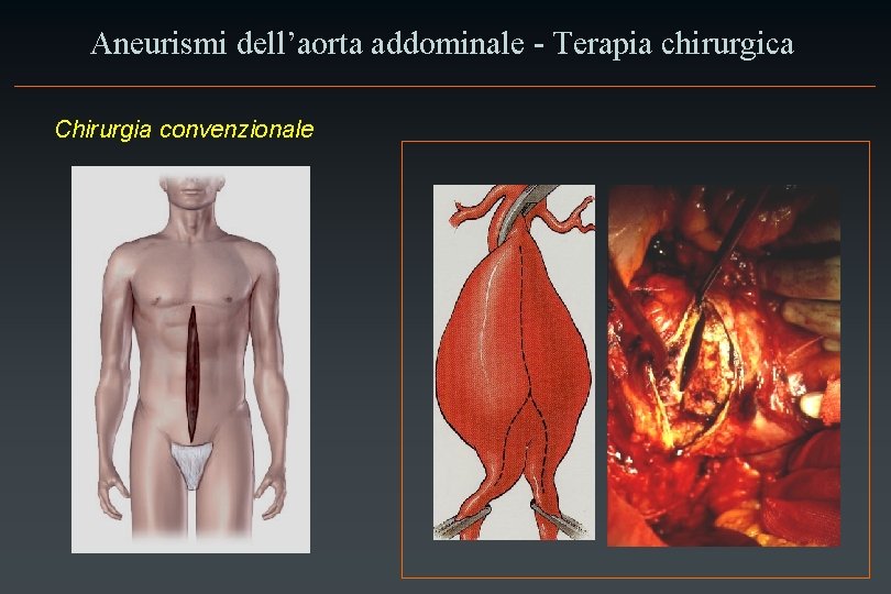 Aneurismi dell’aorta addominale - Terapia chirurgica Chirurgia convenzionale 