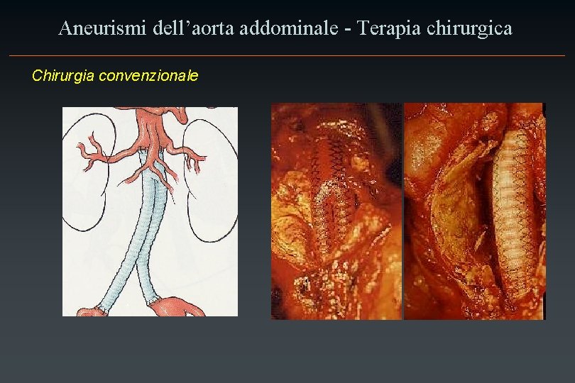 Aneurismi dell’aorta addominale - Terapia chirurgica Chirurgia convenzionale 