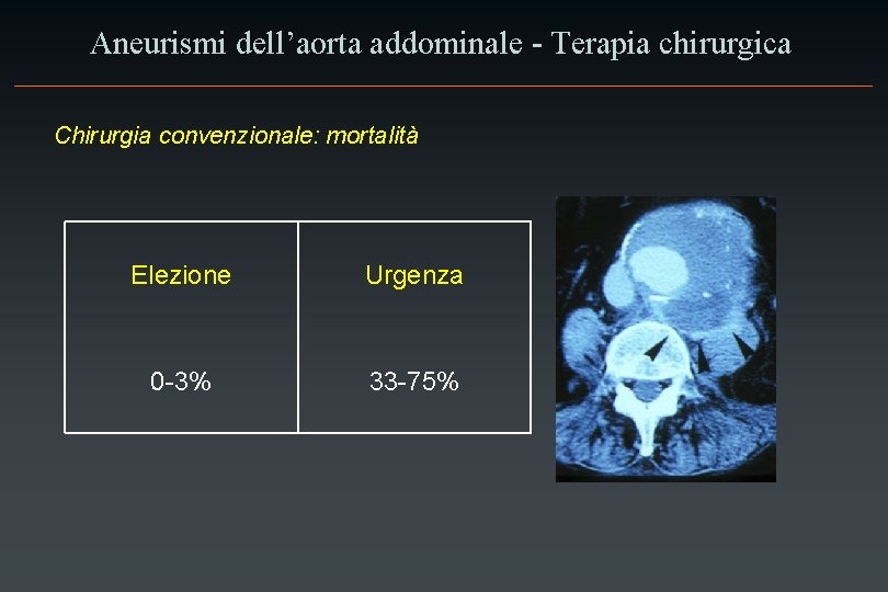 Aneurismi dell’aorta addominale - Terapia chirurgica Chirurgia convenzionale: mortalità Elezione Urgenza 0 -3% 33