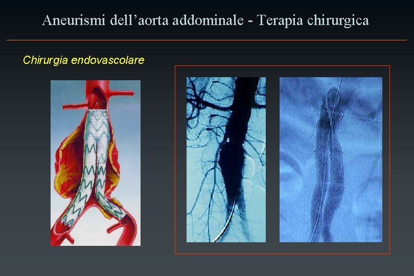 Aneurismi dell’aorta addominale - Terapia chirurgica Chirurgia endovascolare 