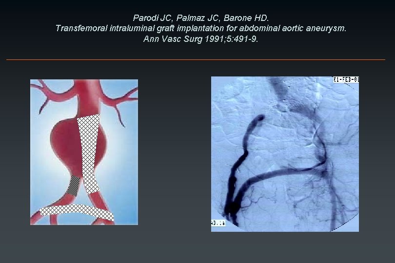 Parodi JC, Palmaz JC, Barone HD. Transfemoral intraluminal graft implantation for abdominal aortic aneurysm.