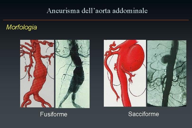 Aneurisma dell’aorta addominale Morfologia Fusiforme Sacciforme 